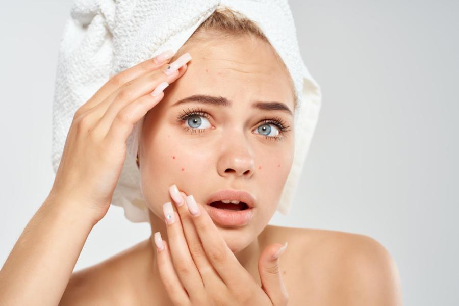 Acne Treatment