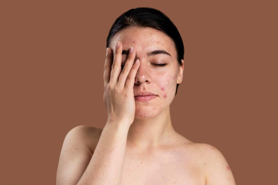 Pigmentation treatments