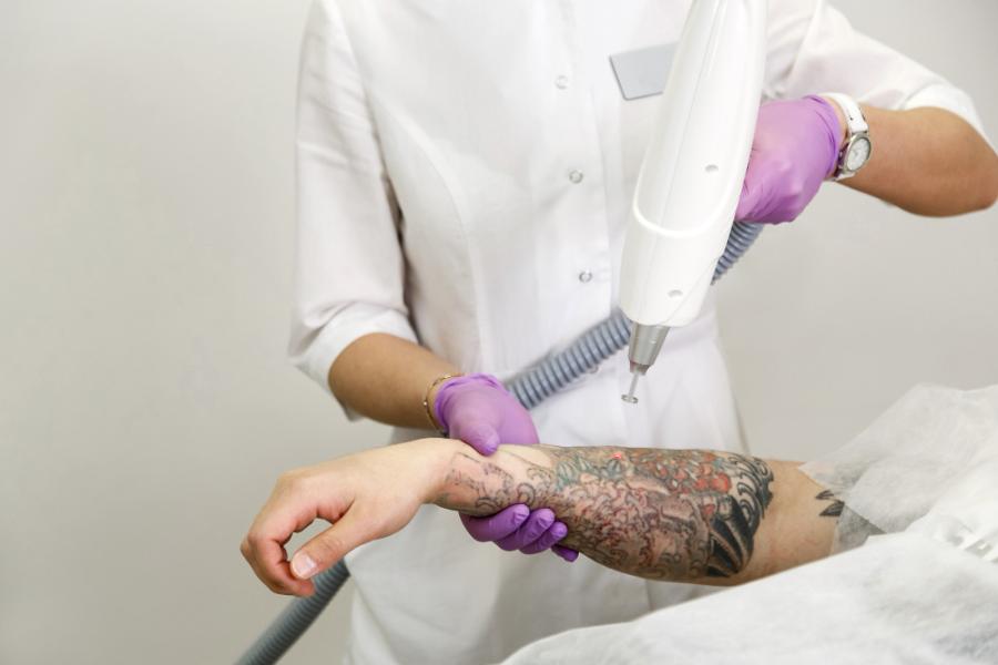Tattoo Removal with Advanced Laser Technology