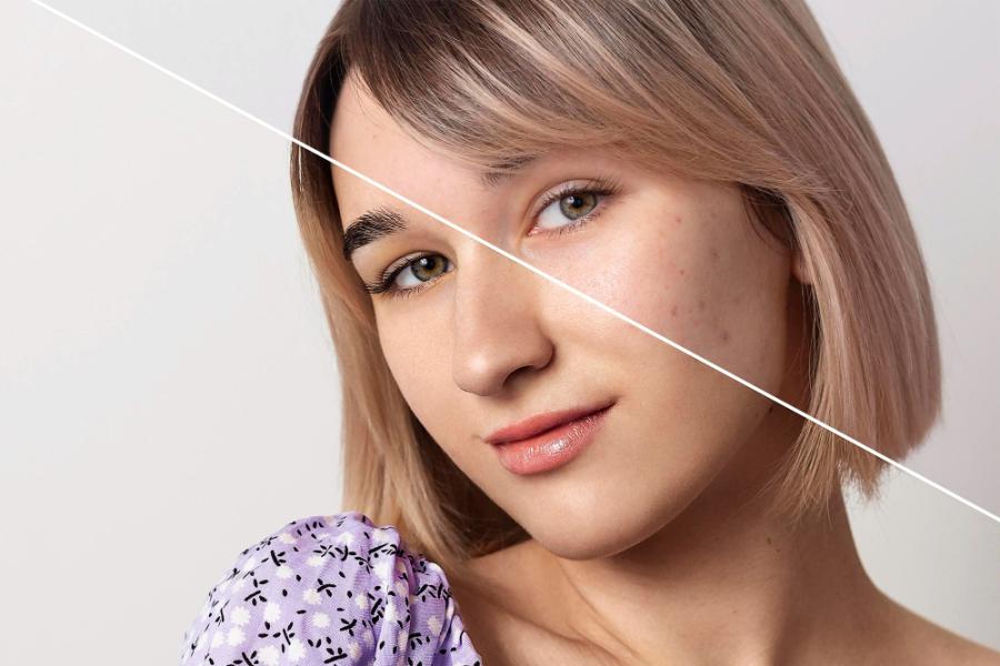 Melasma and Hyperpigmentation