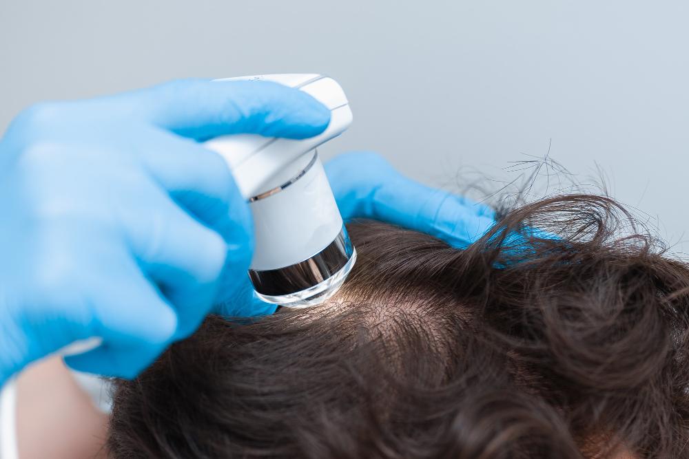 PRP and Laser Therapy for Optimal Hair Restoration