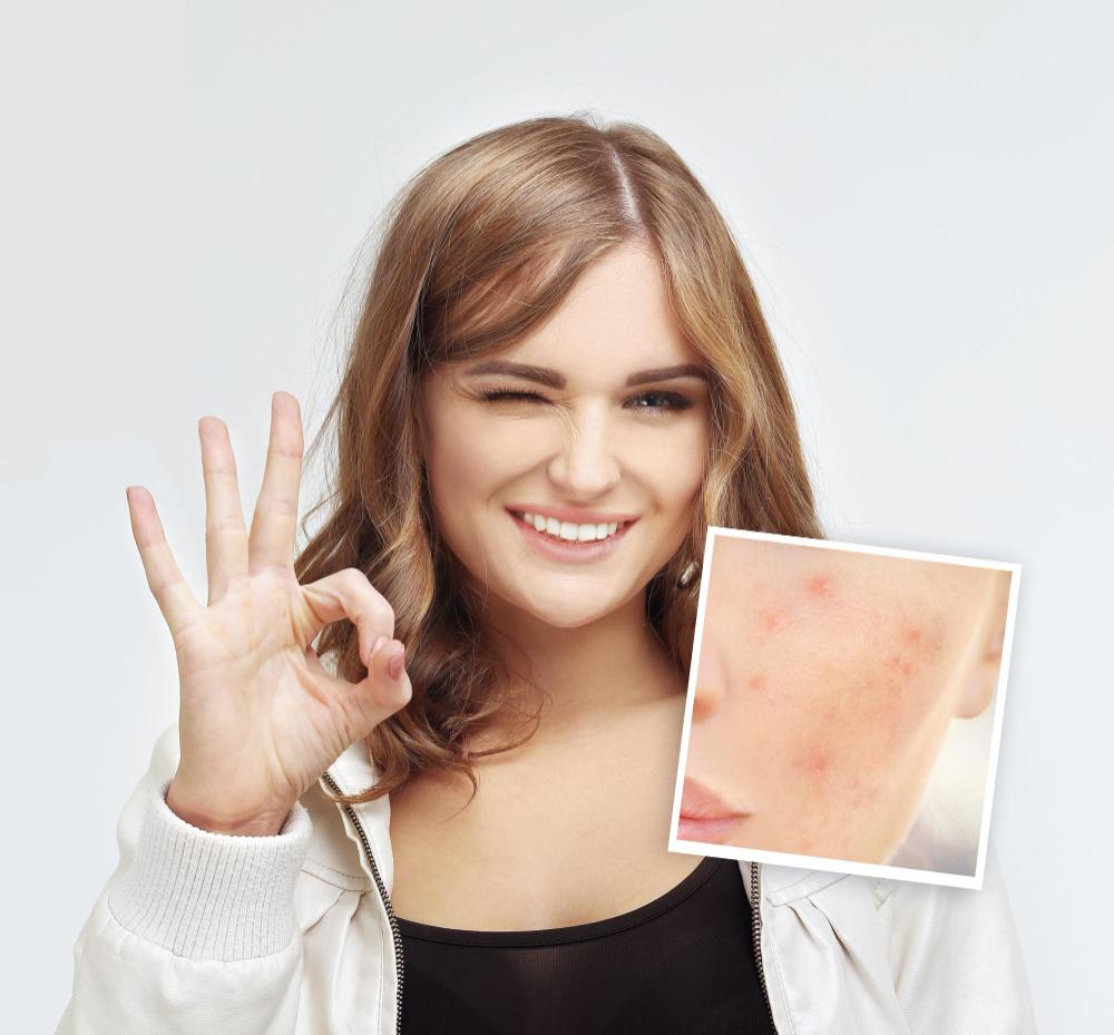 Post-Acne Skin